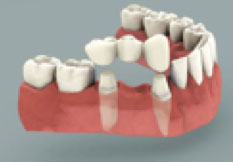 Brobehandling tand